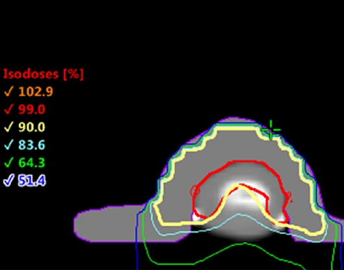 SCC Right Index Finger Isodose Distribution