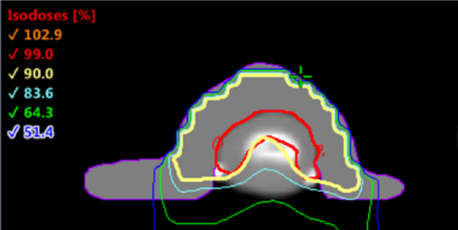 SCC Right Index Finger Isodose Distribution