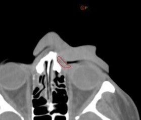 Figure 8: The first day CBCT showed a small air gap of 1 mm between then bolus and the patient near the eyelid; but overall, the bolus showed an excellent fit.