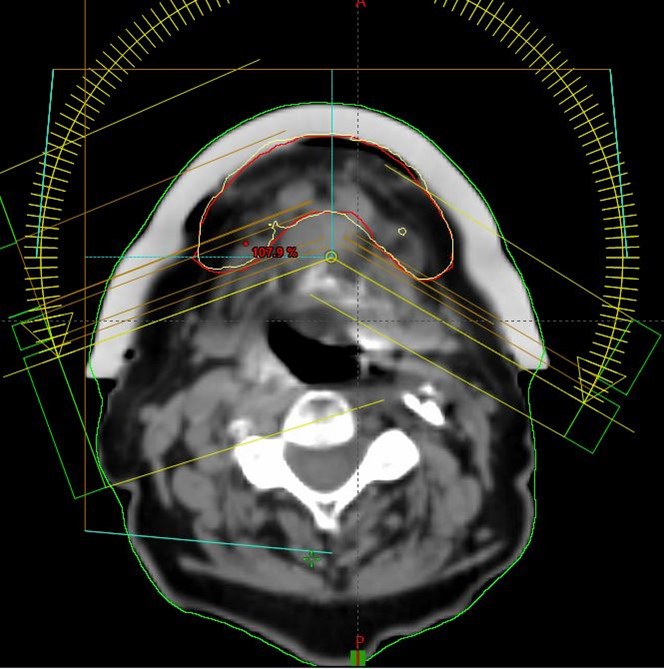 Figure 5. (B): VMAT plan in Eclipse TPS: Screenshots showing prescription isodose line conformity (yellow) with PTV (red).