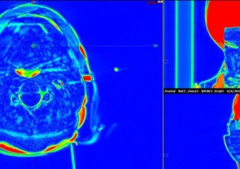 Figure 8. Example of image difference review for daily CBCT and planning CT showing minimal airgap