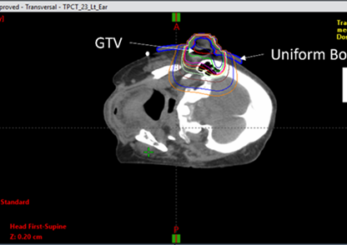 Figure 3(A): Plan with a uniform thickness bolus