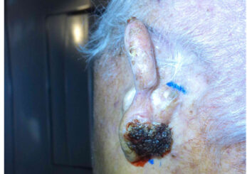 Figure 1: Squamous cell carcinoma of the left ear.